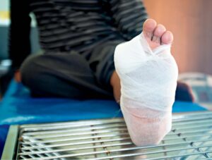 amputation of part of the foot